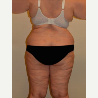 45-54 year old woman treated with Liposuction before 3658219