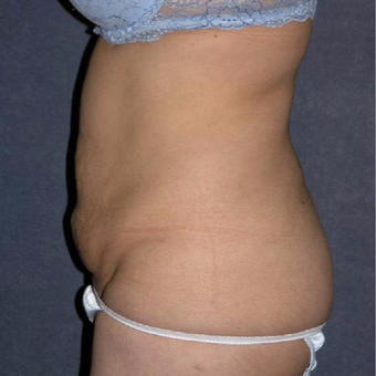 45-54 year old woman treated with Tummy Tuck before 3453629