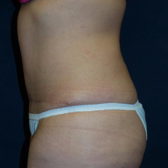 45-54 year old woman treated with Tummy Tuck after 3453629