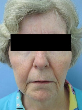 Wrinkle treatment on woman's lip, jaw and cheek areas before 851432