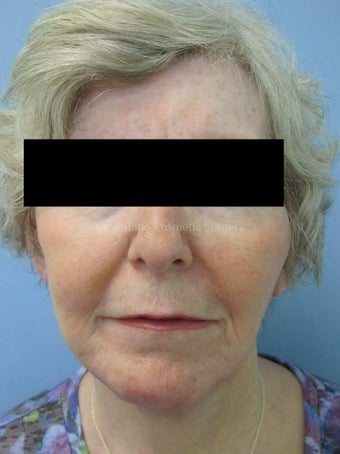 Wrinkle treatment on woman's lip, jaw and cheek areas after 851432