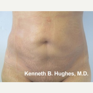 Liposuction after 3094217