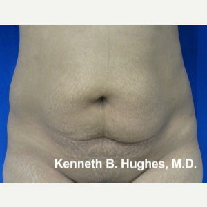 Liposuction before 3094217
