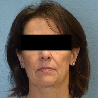 65-74 year old woman treated with Laser Skin Resurfacing before 3253466