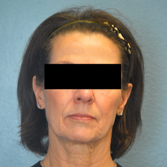 65-74 year old woman treated with Laser Skin Resurfacing after 3253466