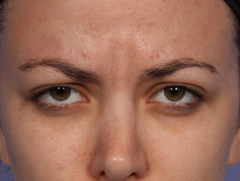 Botox Between Eyebrows before 302214