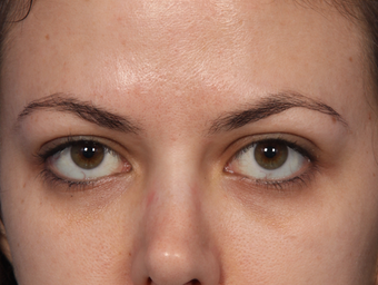 Botox Between Eyebrows after 302214