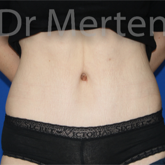 25-34 year old woman treated with Tummy Tuck after 3675941