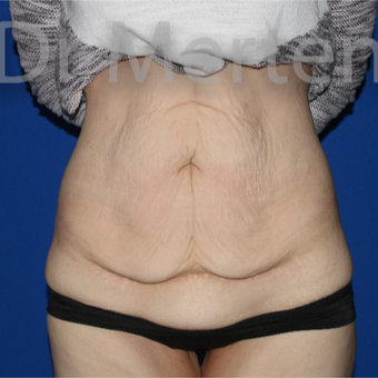 25-34 year old woman treated with Tummy Tuck before 3675941