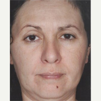 55-64 year old woman treated with Melasma Treatment after 2579558