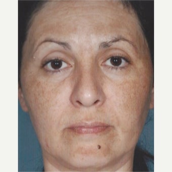 55-64 year old woman treated with Melasma Treatment before 2579558