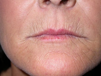 peri oral dermabrasion for smoker's lines before 1032679