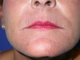 peri oral dermabrasion for smoker's lines after 1032679