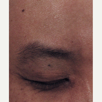 25-34 year old man treated with Birthmark Removal after 3220795
