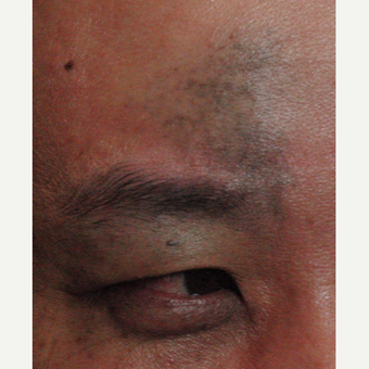 25-34 year old man treated with Birthmark Removal before 3220795
