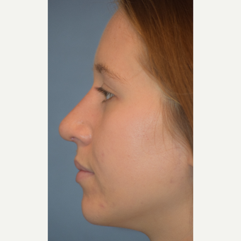 18-24 year old woman treated with Rhinoplasty after 3441905