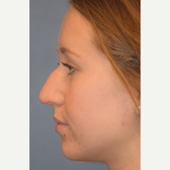 18-24 year old woman treated with Rhinoplasty before 3441905