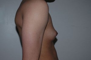 FTM top surgery. Keyhole approach and periarolar mastopexies, (incisions around nipple to decrease size). 1130783