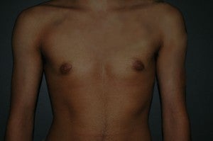 FTM top surgery. Keyhole approach and periarolar mastopexies, (incisions around nipple to decrease size). after 1130783