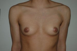 FTM top surgery. Keyhole approach and periarolar mastopexies, (incisions around nipple to decrease size). before 1130783