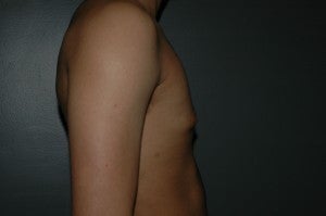 FTM top surgery. Keyhole approach and periarolar mastopexies, (incisions around nipple to decrease size). 1130783