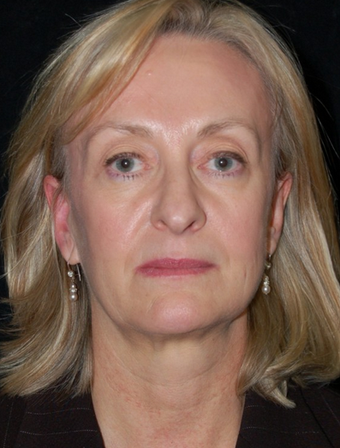 Nose Surgery - Rhinoplasty before 1253173