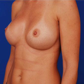 Breast Augmentation - 25-34 Year Old Mother of Two after 3165720