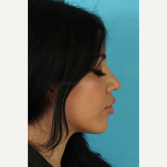 25-34 year old woman treated with Rhinoplasty after 3691335