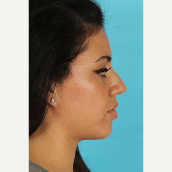25-34 year old woman treated with Rhinoplasty before 3691335