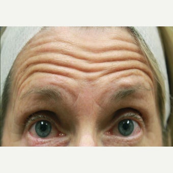 65-74 year old woman treated with Dysport before 1634145
