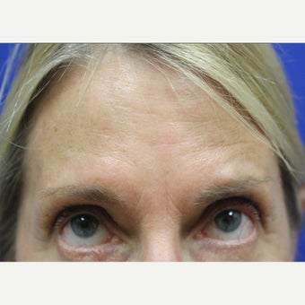 65-74 year old woman treated with Dysport after 1634145