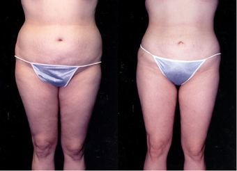 23-year-old woman treated with Liposuction. before 574534