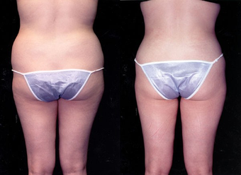 23-year-old woman treated with Liposuction. after 574534