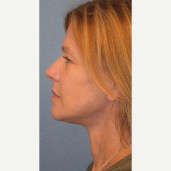 55-64 year old woman treated with Facelift after 3501541