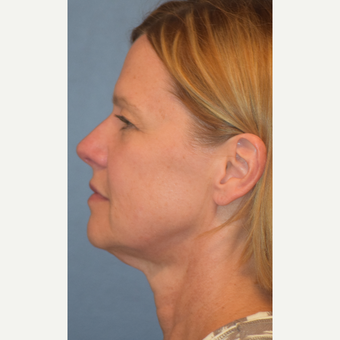 55-64 year old woman treated with Facelift before 3501541