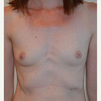 35-44 year old woman treated with Breast Reconstruction before 3092996