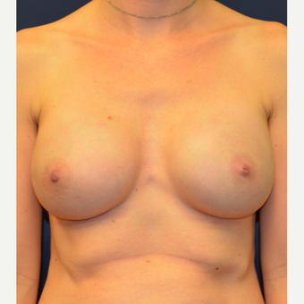 35-44 year old woman treated with Breast Reconstruction after 3092996