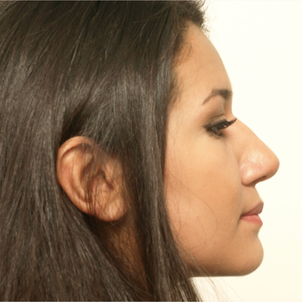 17 or under year old woman treated with Rhinoplasty after 3418731