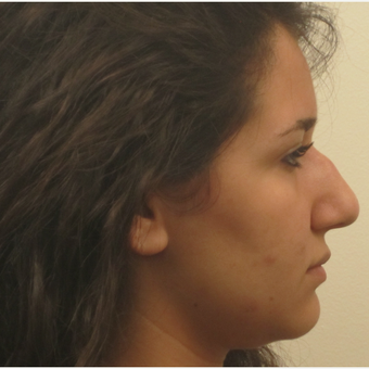 17 or under year old woman treated with Rhinoplasty before 3418731