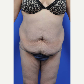 35-44 year old woman treated with Tummy Tuck before 3455274