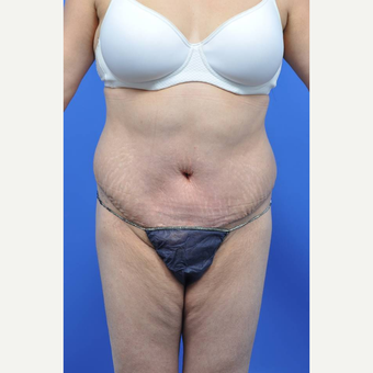 35-44 year old woman treated with Tummy Tuck after 3455274