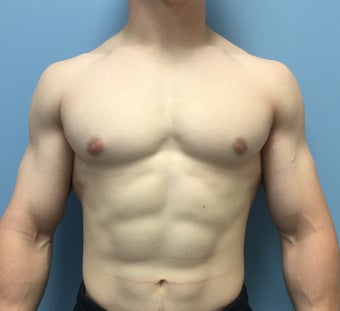 18-24 year old man treated for Male Breast Reduction after 2303796