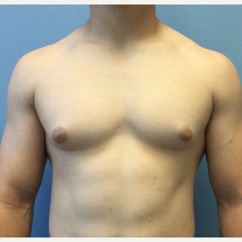 18-24 year old man treated for Male Breast Reduction before 2303796