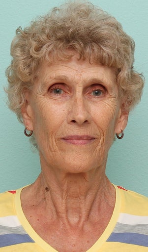 Female Treated for Wrinkles on face with Contour TRL Laser Resurfacing Treatment Using Sciton Joule Laser before 1230857