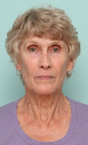 Female Treated for Wrinkles on face with Contour TRL Laser Resurfacing Treatment Using Sciton Joule Laser after 1230857