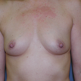 51 year old woman treated with Breast Augmentation before 3207288