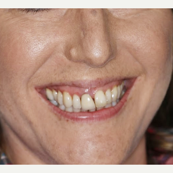 Replacing Dental Crowns with new Ceramic crowns before 3093729