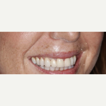 Replacing Dental Crowns with new Ceramic crowns after 3093729
