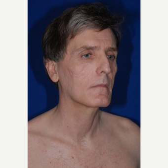 35-44 year old man treated with Fat Transfer before 3783854