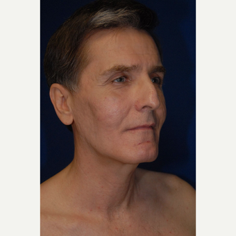 35-44 year old man treated with Fat Transfer after 3783854